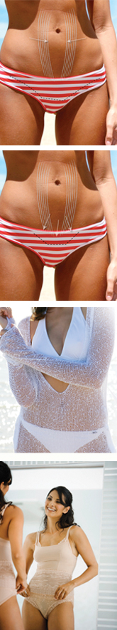 Abdominoplasty Tummy Tuck Image 1