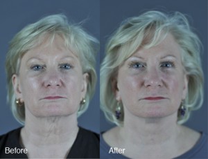 Facelifts before and after
