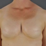 Breast recon post-op
