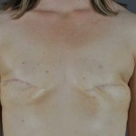 Breast recon pre-op