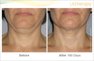 ultherapy_0026-0086w_beforeandafter_180day_1tx_neck1
