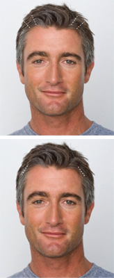 Male Brow Lift Model Face