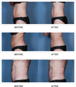 Real Patients Before and After Liposonix Treatment