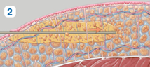 Ultrasound probes shake fat cells apart, and the mix with fluid.