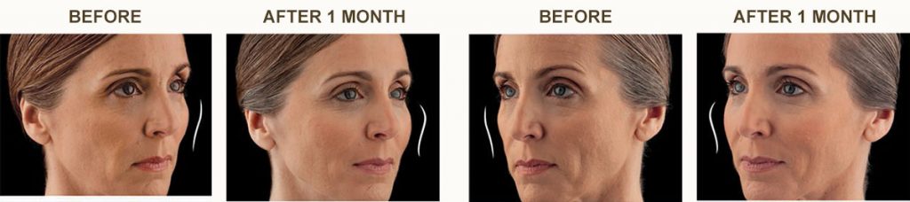 Juvederm Voluma Patient Before and After Procedure