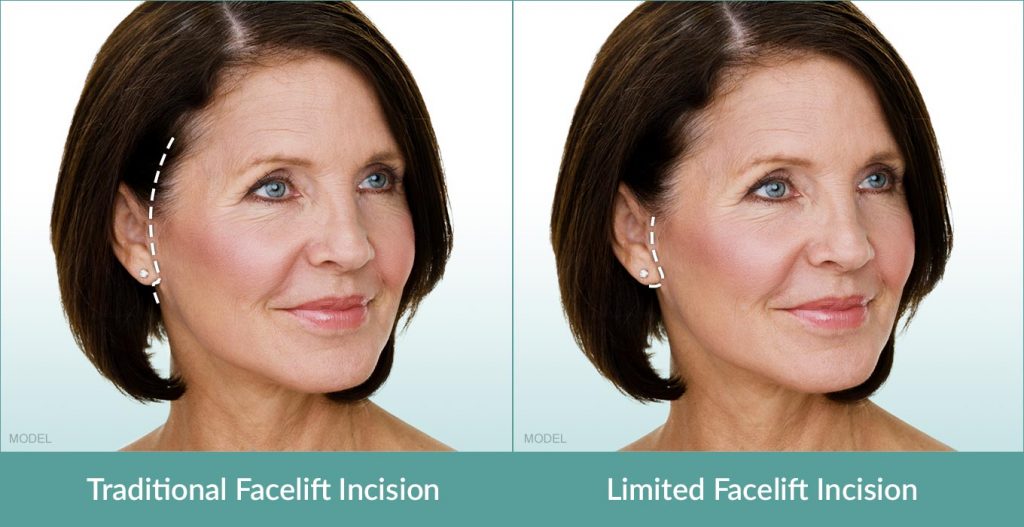 Facelift Incision Options