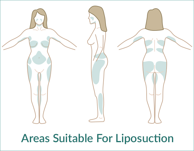 Areas suitable for liposuction