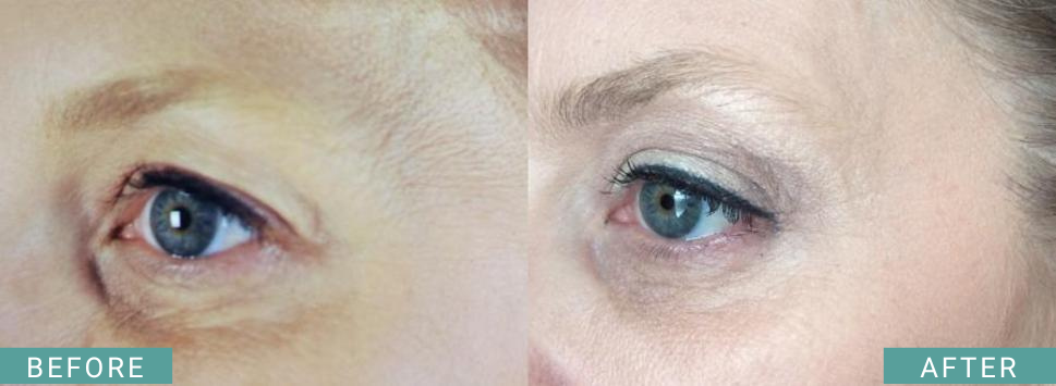 Ultherapy Results