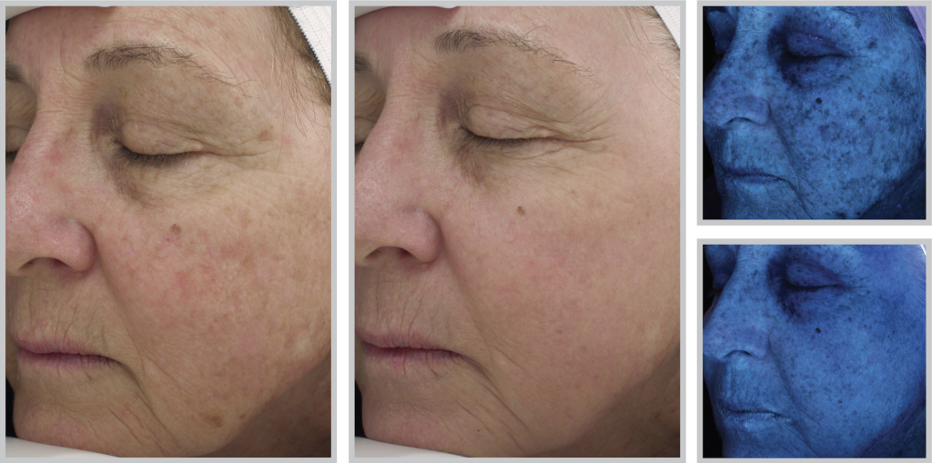 Woman before and after HALO Hybrid Laser treatment